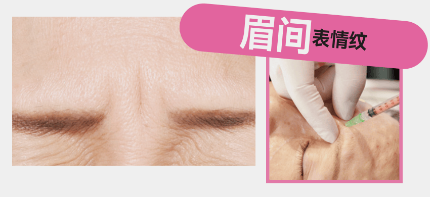 醫療美容 | 表情紋、眼周紋、法令紋，針對性改善！
